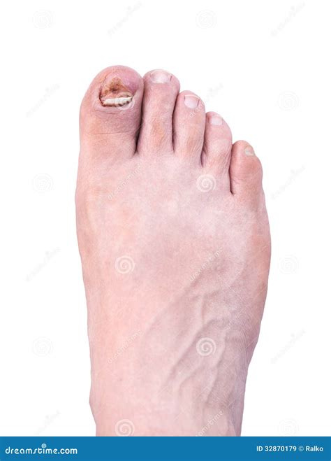 Broken nail stock image. Image of skin, medical, healthcare - 32870179