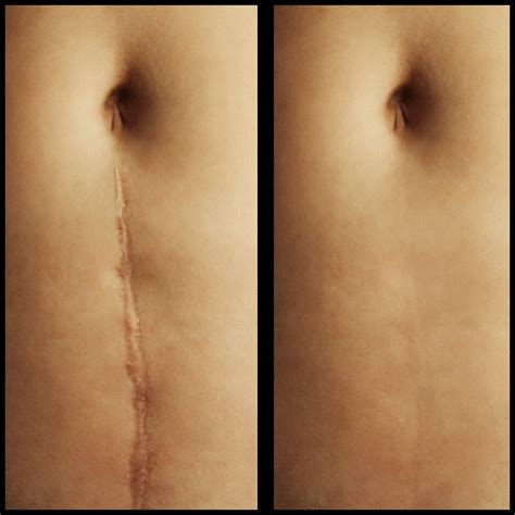 What is Scar Revision Surgery? | Annapolis and Severna Park, MD