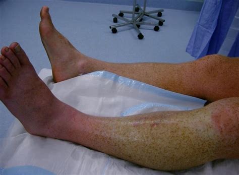 compartment syndrome pictures treatment  surgery hubpages