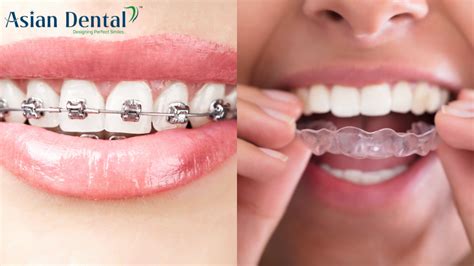 orthodontic treatment index  orthodontic treatment rxdlb