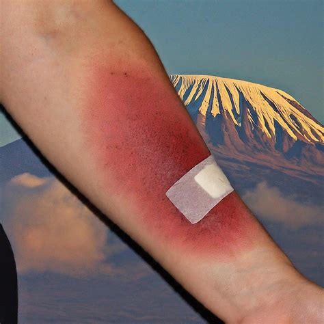 Rash From Mounjaro Side Effects: Identifying Common Risks