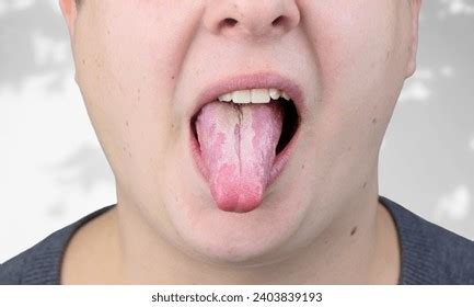 Infection Tongue Disease Candida Albicans Stock Photo 2403839193 | Shutterstock