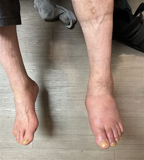 Question of the Week | What's Wrong with JR's Foot? - Diabetes