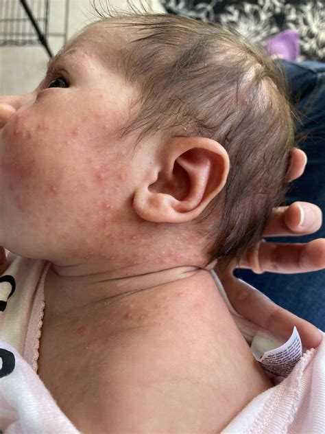 Baby acne? Allergy? Eczema : r/breastfeeding