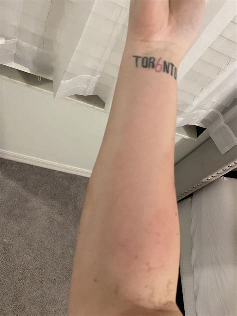 Blood Clot In Forearm Deep Vein Thrombosis (DVT) Symptoms, Signs And