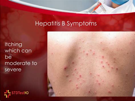PPT - 10 Common Symptoms Of Hepatitis B Infection PowerPoint
