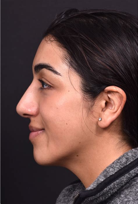 Non-Surgical / Liquid Rhinoplasty Case 21746
