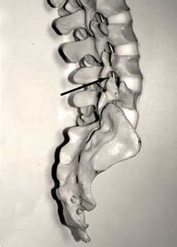 lumbar nerve root block minimally invasive treatment