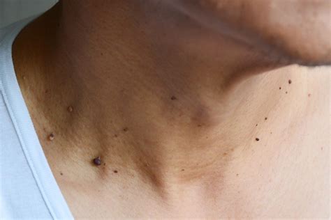 12 Silent Signs of Skin Cancer You May Be Ignoring | The Healthy