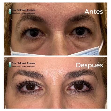 Valor Blefaroplastia Superior E Inferior