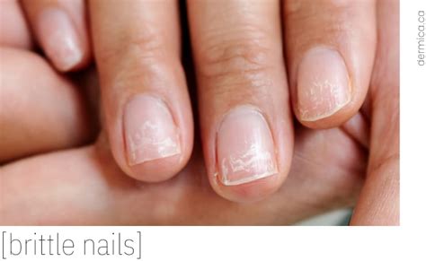 Brittle Nails Treatment - Dérmica MedEsthetics