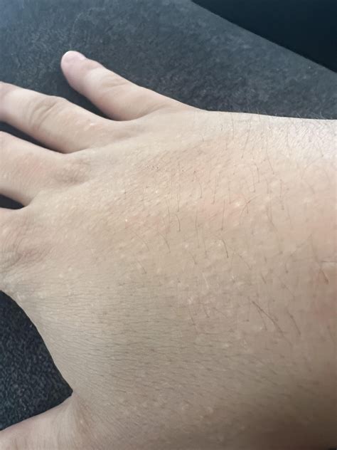 Weird white bumps on hands : r/Dermatology