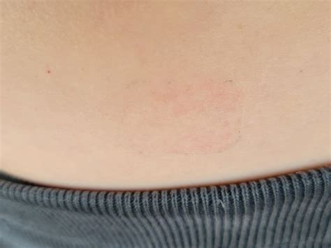 Weird reaction to estrogen patch. Is this normal? : r/Menopause