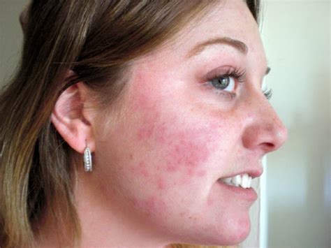 swollen face  rash   health advisor