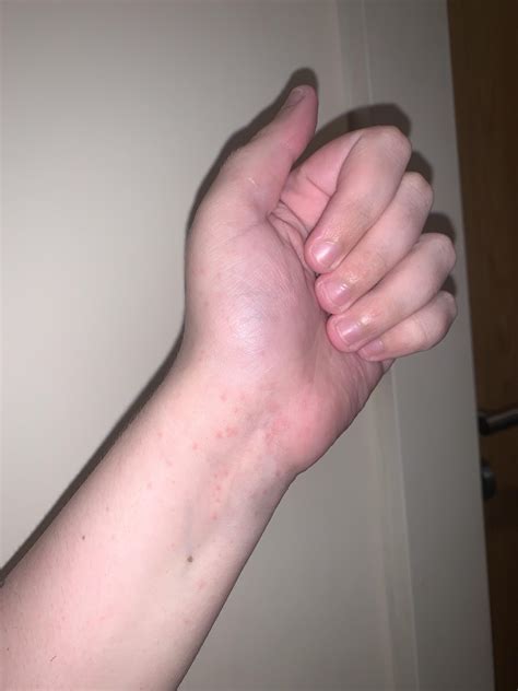 Does this look like scabies? : r/scabies
