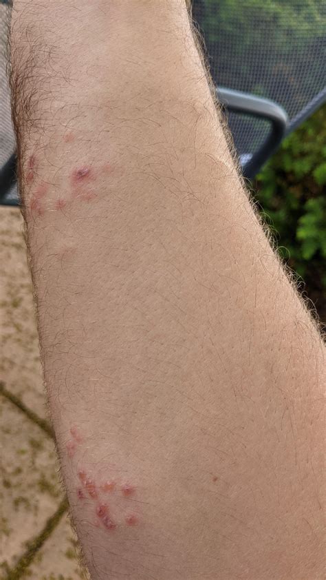 Shingles on Knuckles? [26M] : r/shingles