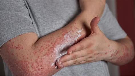 psoriasis        chronic autoimmune