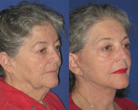 Laser Lipo Nashville Tn at Nancy Milne blog