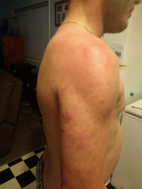 Alcohol rash? My missus has pointed this put for the third time. I have