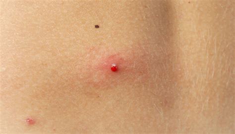 Bolha De Sangue Na Pele - Pintas vermelhas na pele: o que são essas bolinhas? - Tá Saudável