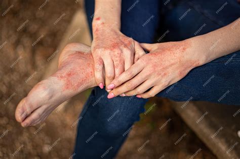 Mãos E Pés Inchados