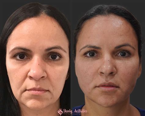 PDO Thread Lifting - Before and After Results at Skinly Aesthetics