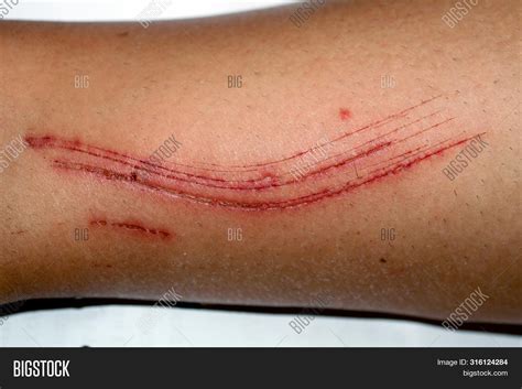 Cut On Skin