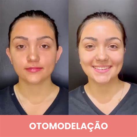 Otomodelação Antes E Depois - Dra. Lúcia Takenaka | Harmonização Facial em Contagem — Otomodelação ...