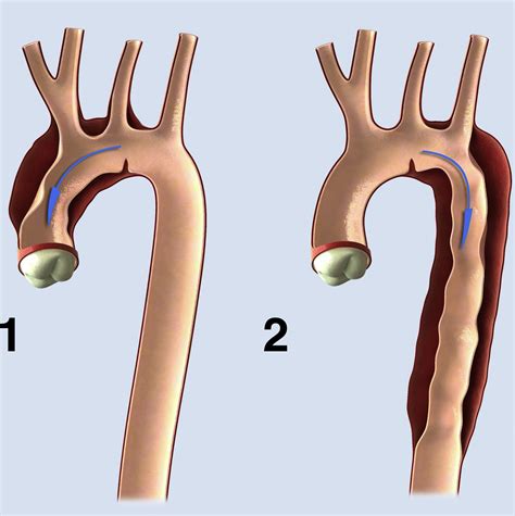 Aortic Dissection