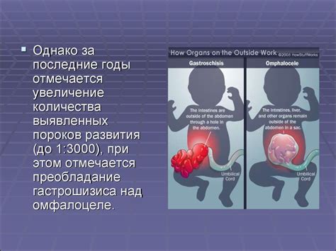 Гастрошизис и омфалоцеле - презентация онлайн