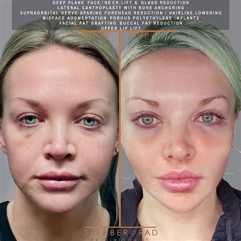 botox  wrong  signs  bad botox    avoid  fix botched