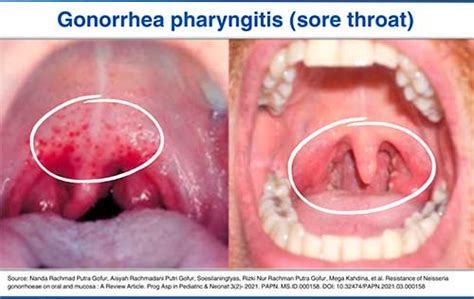 Chlamydia Throat Symptoms