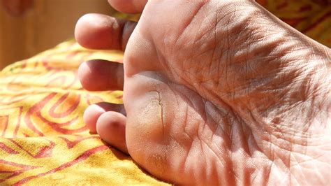 Close up of dry foot 14205727 Stock Video at Vecteezy