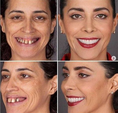 #plasticsurgery #plasticsurgerygonewrong #beforeafter # ...