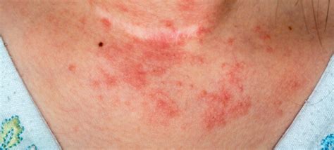 Coceira No Pescoço E Colo - Nem sempre é alergia: saiba o que a coceira pode dizer sobre a sua ...