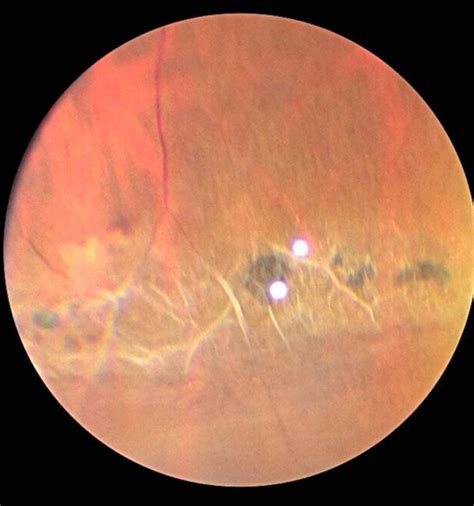 Lattice Degeneration of the Retina - Retina Center of San Diego