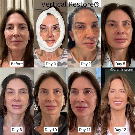Best 13 Facelift Surgery (Rhytidectomy): The Ultimate Guide – Artofit