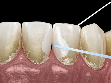 What is Dental Calculus? - Dr. M Center