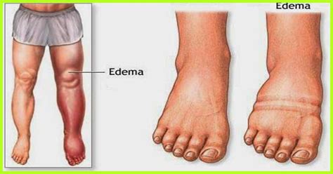 25 remedies to treat edema naturally signs causes types – Artofit
