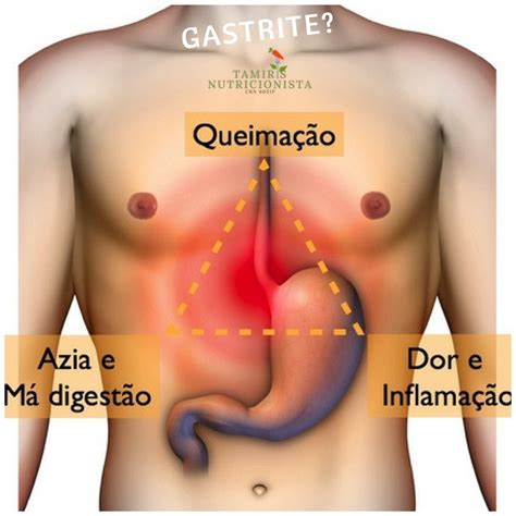Onde Fica A Gastrite
