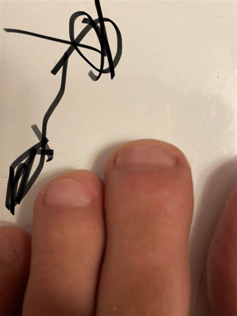 Nail melanoma? : r/Melanoma