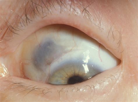 Surgically Induced Necrotizing Scleritis 7
