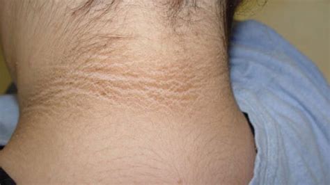 Acanthosis Nigricans: Causes, Symptoms & Treatment » How To Relief