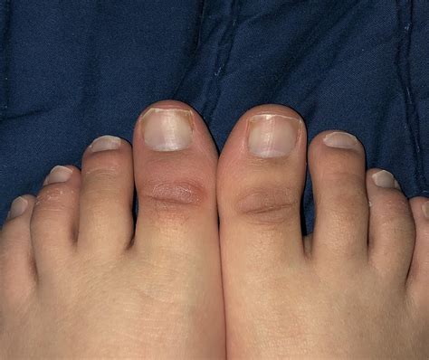 Tough, ugly brown skin on big toes. Anyone know how to get rid of it