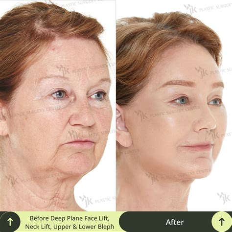 deep plane facelift surgery packages  south korea  aud
