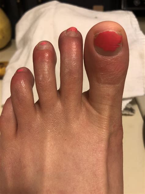 Feet Finger Swelling In Winter at Lisa Teixeira blog
