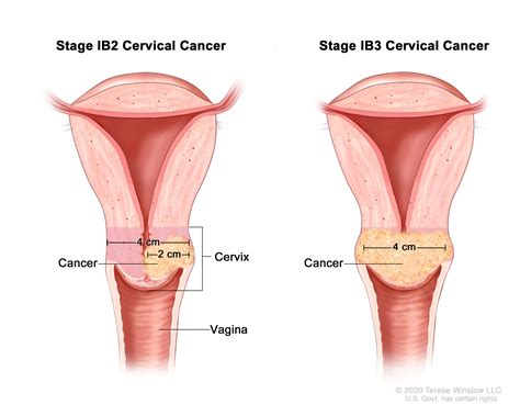 Cervical Cancer Treatment (PDQ®)–Patient Version - NCI