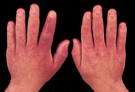 Figure 1 from Papular purpuric rash due to parvovirus B19 with ...