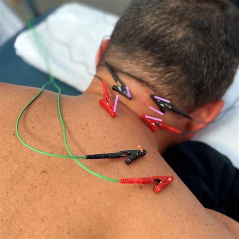 orlando dry needling pursuit physical therapy
