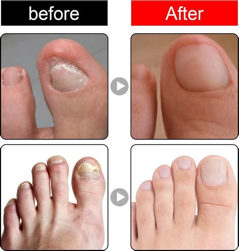 Ingrown Toenail Treatment Nail Helper Nail Growth Treatment Ingrown ...